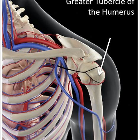 Demonstration of the humeral head intraosseous procedure on the Partial ...