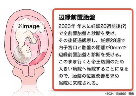 【治療日誌】辺縁前置胎盤10 No1｜伝統鍼灸 楓庵