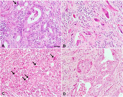 Histopathological Findings In The Tumors Of The Uterus And Kidney A