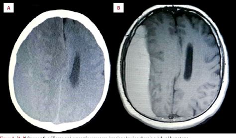 Figure 1 From Epidural Hematoma Complication After Rapid Chronic Subdural Hematoma Evacuation A