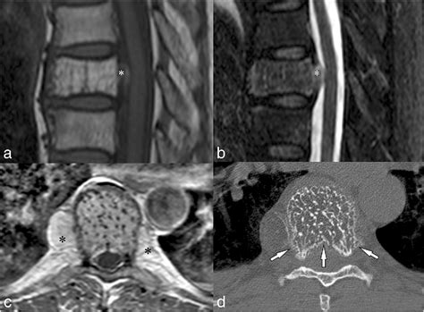 A Systematic Approach To Vertebral Hemangioma Semantic Scholar