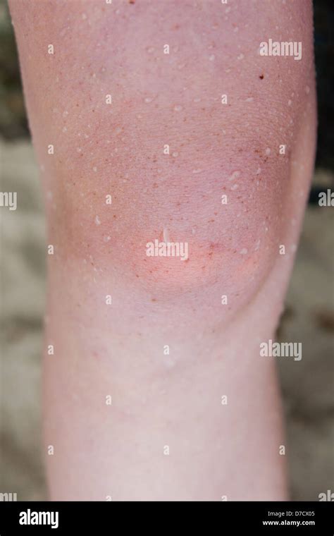 Mottled Skin Hi Res Stock Photography And Images Alamy