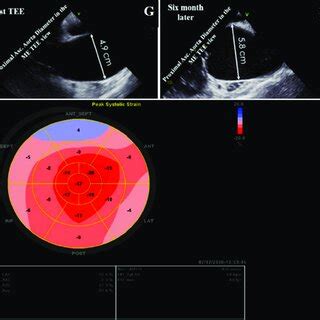 Two-and three-dimensional transthoracic echocardiographic views of case ...