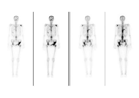 55-year-old female with metastatic breast cancer. On the bone scan ...