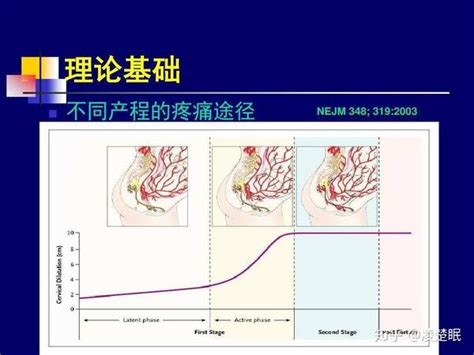 关于分娩镇痛的一切，看这篇文章就够了 知乎