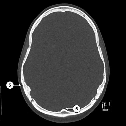 Basal Skull Fracture Complications Symptoms