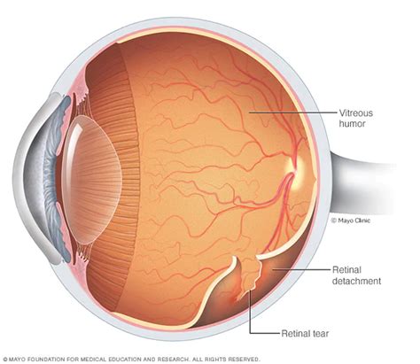 Retinal Tears And Detachments The Eye And Laser Center