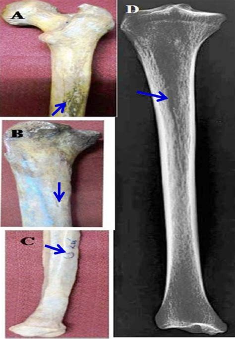 Nutrient Artery Of Humerus