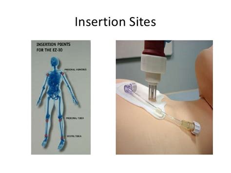 Intraosseous