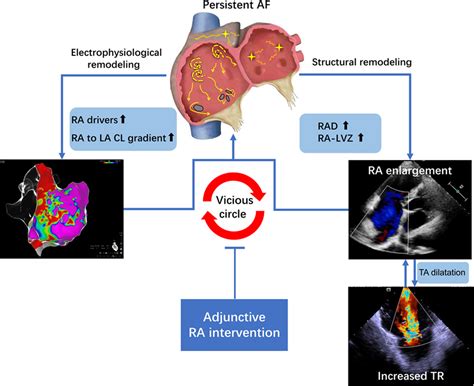 Adjunctive Right Atrial Ablation For Persistent Atrial Fibrillation