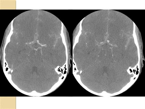 Imaging In Head Trauma