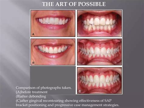 Bracket Positioning For Smile Arc Protection Ppt Free Download