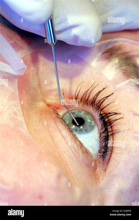 Dpa A Lasik Spatula To Open The Cornea Is Being Positioned Above