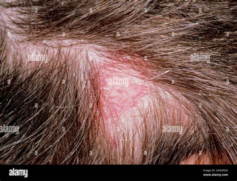 Tinea Capitis Close Up Of A Ringworm Lesion Medical Name Tinea Capitis On The Scalp Of A Man