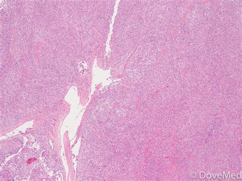 Solitary Fibrous Tumor Of Lung