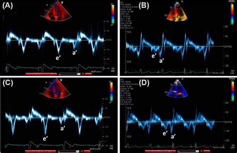 Tissue Doppler Images Showing Mitral Annular Early E And Late A