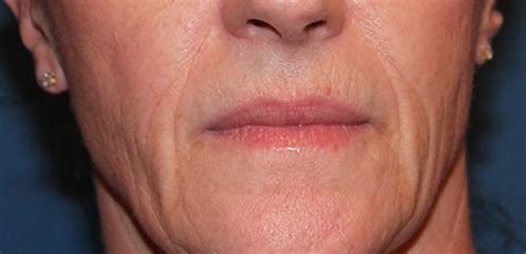 Fractional Laser Skin Resurfacing Case 3 Cascade Facial Surgery And