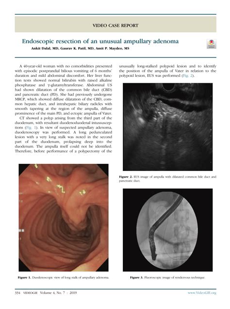 Pdf Endoscopic Resection Of An Unusual Ampullary Adenoma