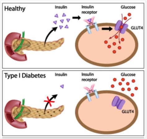 Diabetes Mellitus Flashcards Quizlet