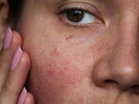 How To Get Rid Of Redness On Your Face According To Dermatologists Self