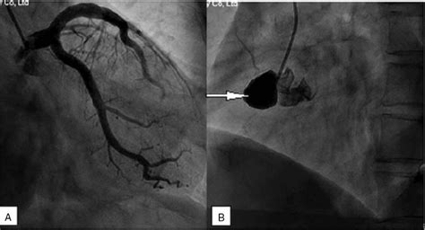 Coronary artery aneurysm combined with other multiple aneury... : Medicine