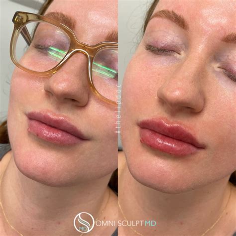 Lip Injection Before After Gallery OMNI SCULPT MD