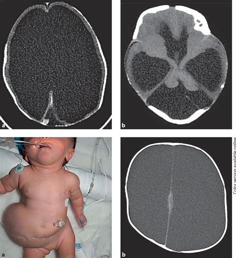 Hydranencephaly Brain