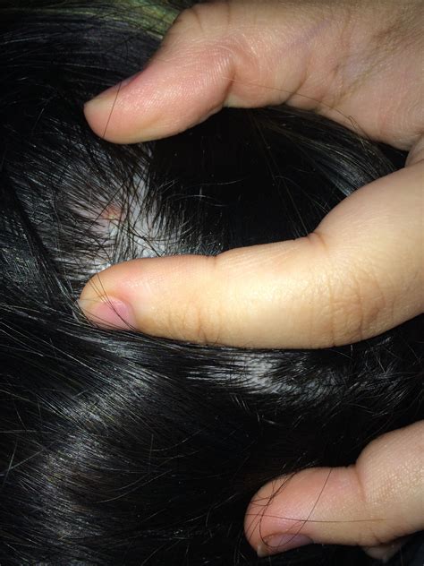 Scalp Pimple Pop