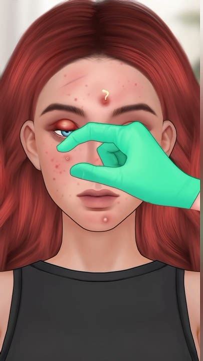 Removal Acne Treatment Asmr Asmr Animation Skin Careasmr