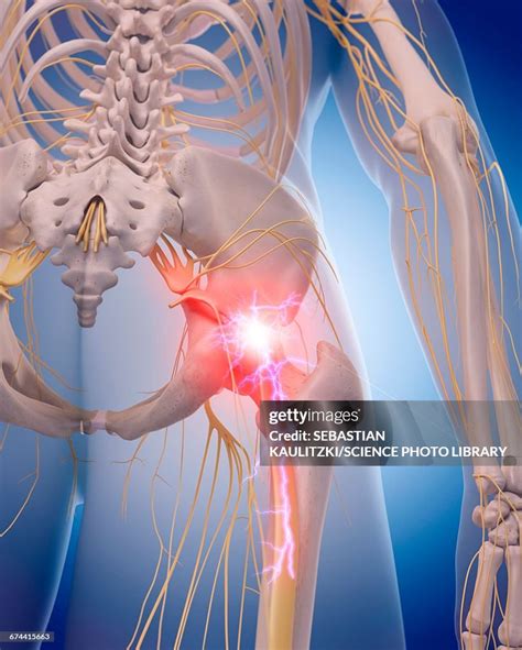 Sciatic Nerve Pain High-Res Vector Graphic - Getty Images