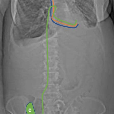 Subclavian Tunneled Access Approach Location Of Central Veins And Download Scientific Diagram