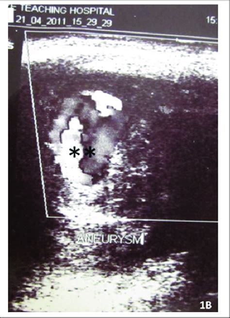 Doppler Ultrasound Image Showing Turbulent Flow Within The