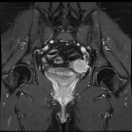 Unicornuate Uterus With Renal Anomaly Image Radiopaedia Org