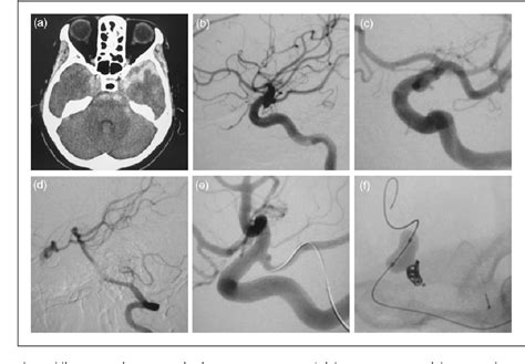 Figure 2 From Parent Artery Occlusion For Ruptured True Posterior