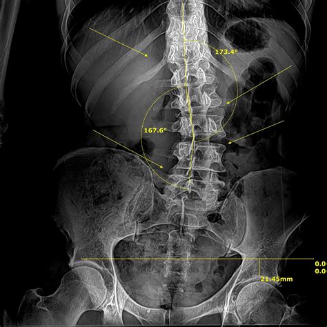 🌟 **Back, Hip, or... - Los Angeles Spinal Decompression ™ | Facebook
