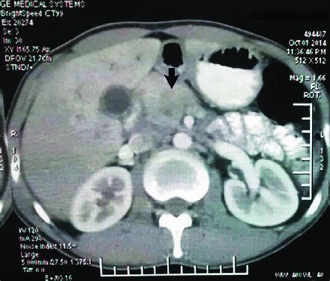 Contrast Enhanced Computed Tomography Of The Abdomen Showing A