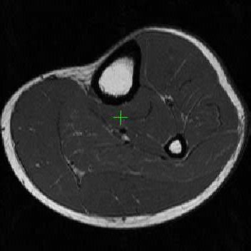 1: MRI Data of Calf Muscles (courtesy [Essafi et al. 2009a ...