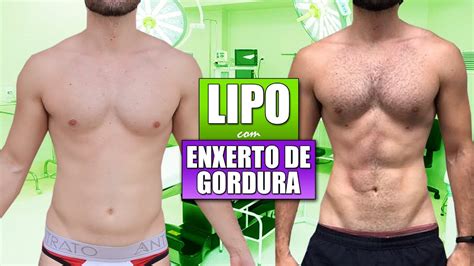 ANTES E DEPOIS DA LIPOESCULTURA ENXERTO NO PEITORAL CIRURGIA