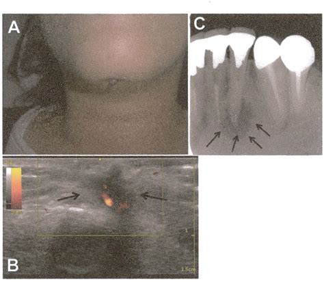 Figure From Usefulness Of Ultrasonography For Rapidly Diagnosing