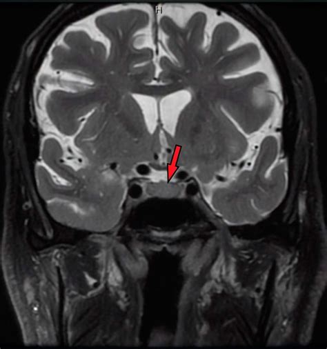 Pituitary Anatomy MRI