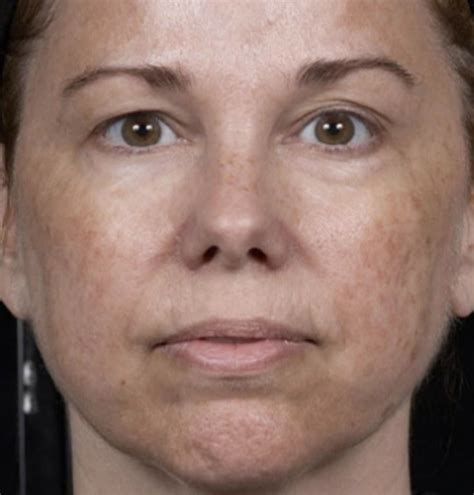 Laser Skin Resurfacing Bodylab Med Spa Santa Cruz