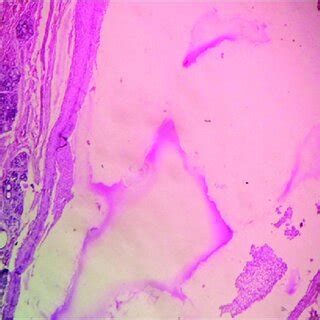 Mucous retention cyst (10× magnification) | Download Scientific Diagram