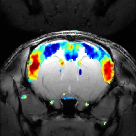 Brain Fmri Scan