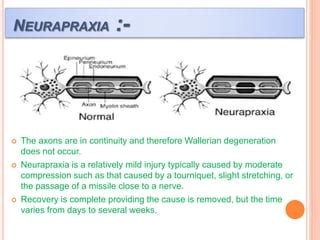 Peripheral nerve injury | PPT