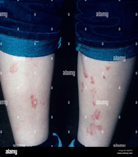 Itchy Skin Rash Stock Photos & Itchy Skin Rash Stock Images - Alamy