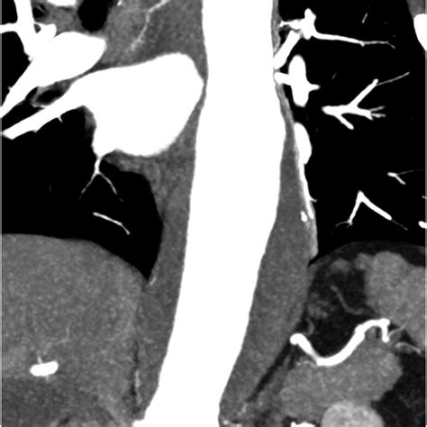 Pre Operative Computed Tomography Angiogram Download Scientific Diagram