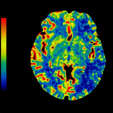 Ct Perfusion 4d Neuro Ge Healthcare United States