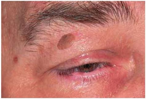 Benign Tumors of the Eyelid Epidermis | Ento Key