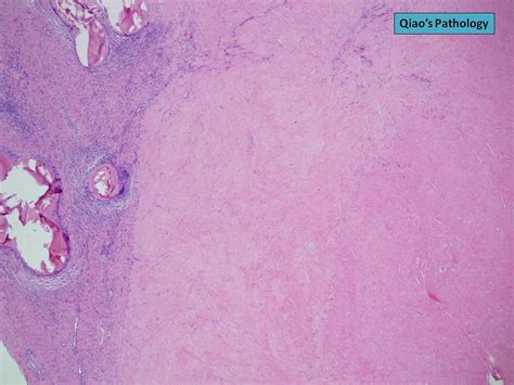 Qiaos Pathology Uterine Artery Embolization Of Leiomyoma Fibroid