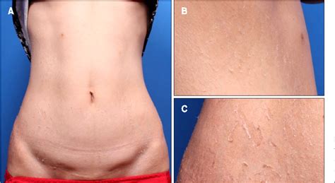 Figure 1 from A Case of Late-Onset Peeling Skin Syndrome Likely Triggered by Irritation ...